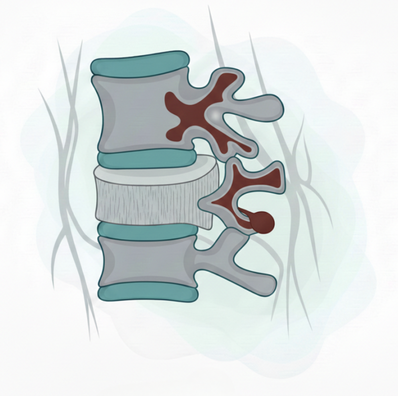 lustración de hernia discal lumbar comprimiendo las raíces nerviosas de la columna vertebral.