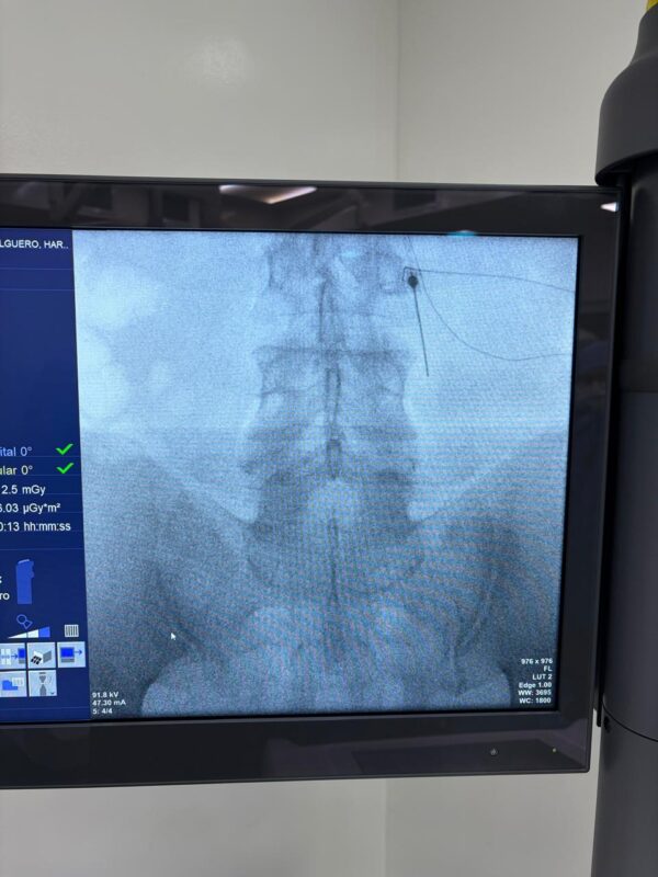 Imagen de fluoroscopia utilizada para guiar procedimientos de neurointervencionismo y tratamiento endovascular de enfermedades cerebrovasculares.