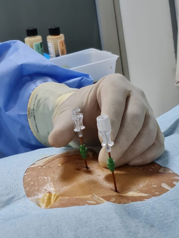 El acceso vascular permite introducir catéteres especializados para tratar enfermedades cerebrovasculares mediante técnicas mínimamente invasivas.